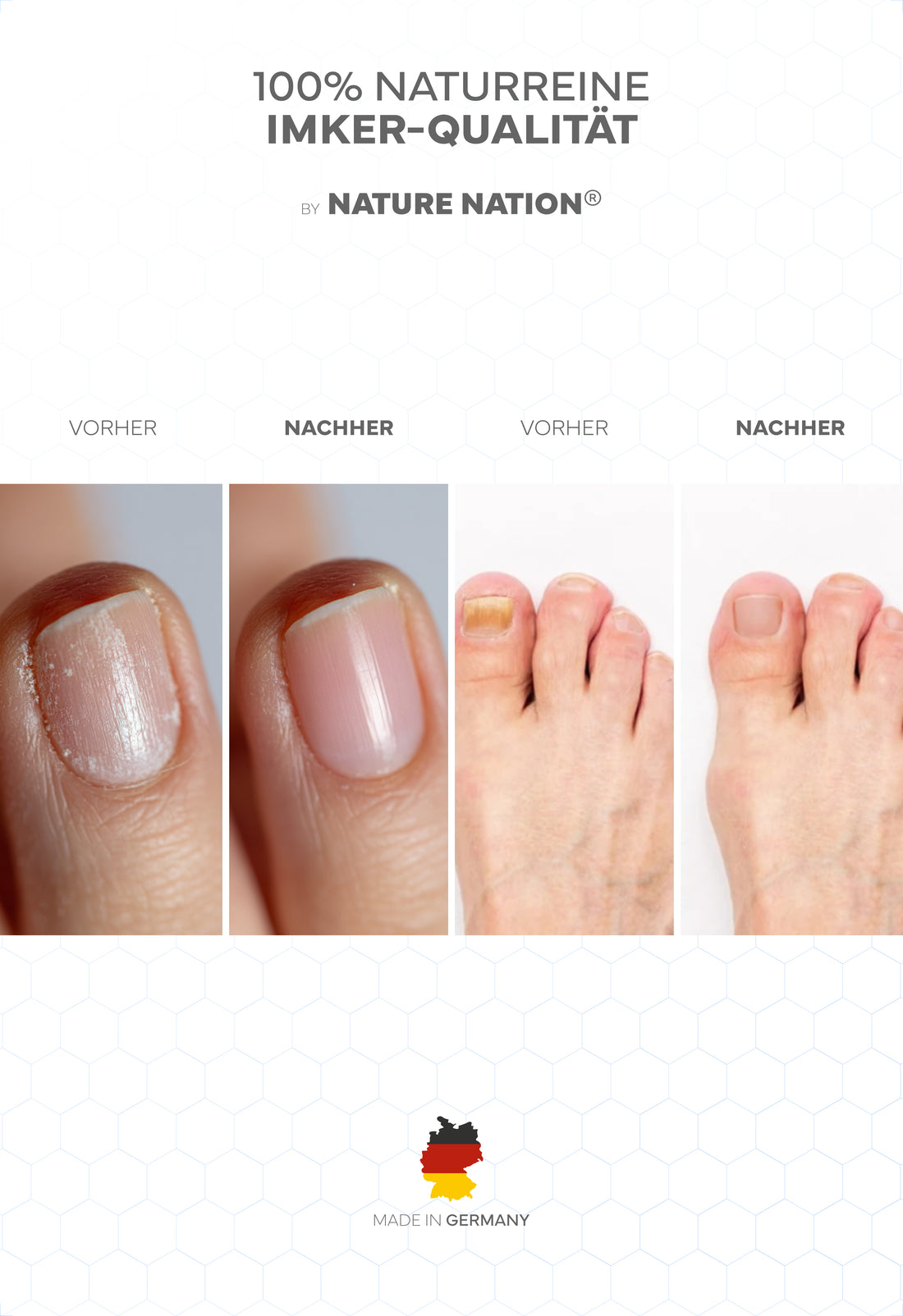 Propolis Nagelserum, 10ml - Akutpflege bei Nagelpilz, mit hochdosiertem Bio-Propolisextrakt sowie Teebaumöl, Zink, Selen & Biotin, für gesunde & starke Nägel